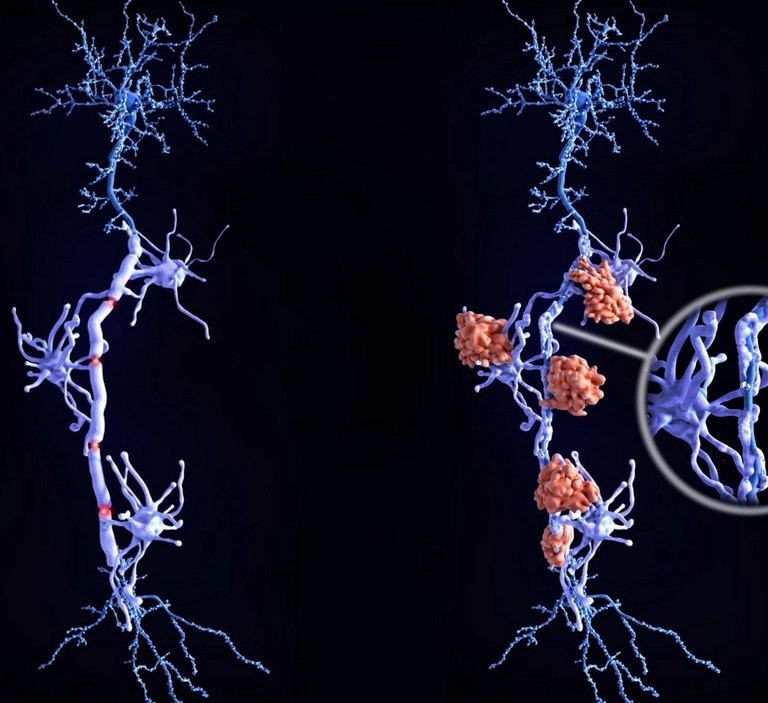 کشف نشانه‌هایی از ابتلا به ام‌اس که پیش از بروز علائم قابل‌شناسایی است