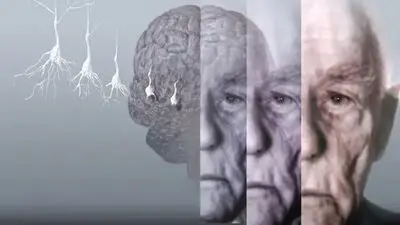 دو دهه تا انفجار آلزایمر در ایران